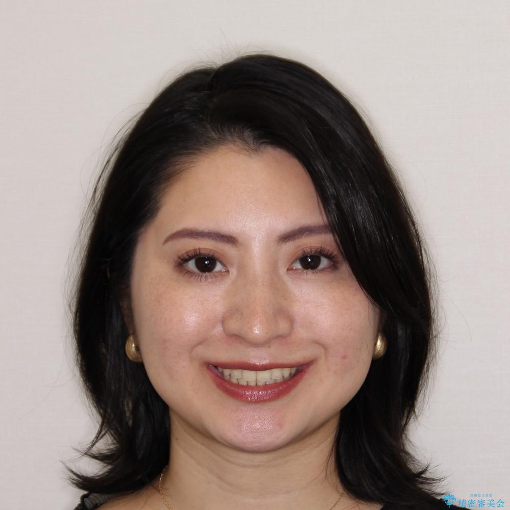 【モニター】インビザラインをしっかり使って短期間矯正治療の治療後(顔貌)