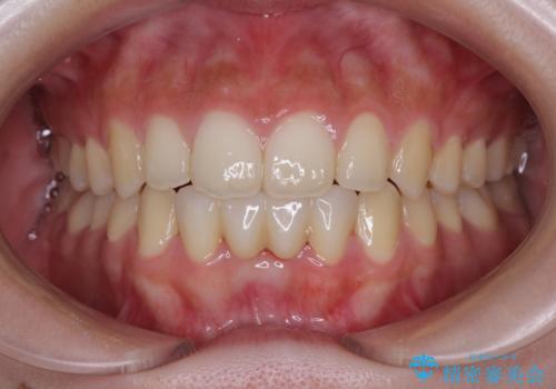 乳歯残存と欠損の前歯　矯正治療とオールセラミックブリッジ治療