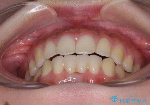 乳歯残存と欠損の前歯 矯正治療とオールセラミックブリッジ治療の治療後