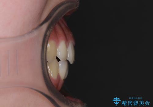 乳歯残存と欠損の前歯 矯正治療とオールセラミックブリッジ治療の治療後