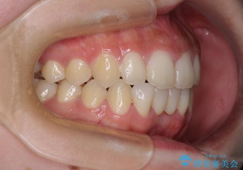 乳歯残存と欠損の前歯　矯正治療とオールセラミックブリッジ治療の治療後