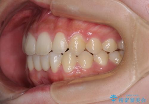 乳歯残存と欠損の前歯 矯正治療とオールセラミックブリッジ治療の治療後