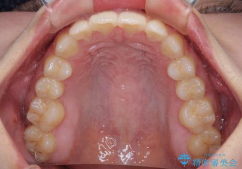 乳歯残存と欠損の前歯　矯正治療とオールセラミックブリッジ治療の治療後