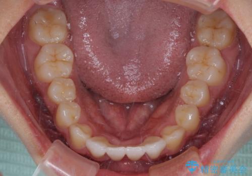 乳歯残存と欠損の前歯 矯正治療とオールセラミックブリッジ治療の治療後