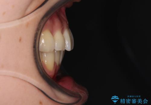 前にずれた咬み合わせをワイヤー装置でしっかりと改善の治療後