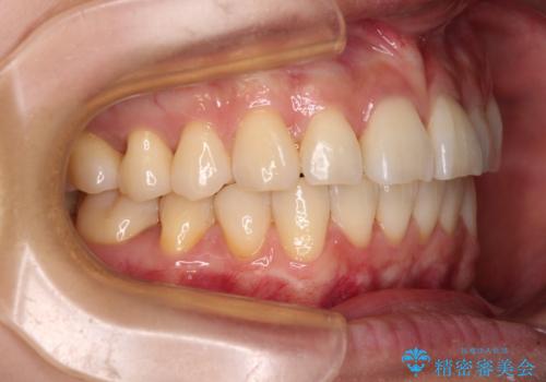 前にずれた咬み合わせをワイヤー装置でしっかりと改善の治療後