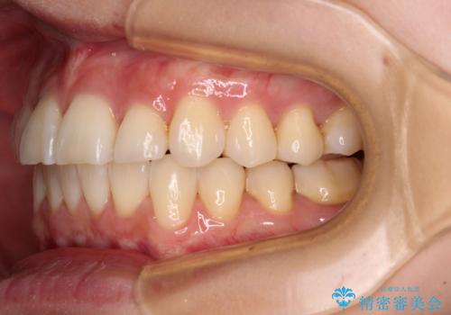 前にずれた咬み合わせをワイヤー装置でしっかりと改善の治療後