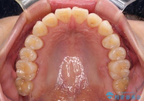 前にずれた咬み合わせをワイヤー装置でしっかりと改善の治療後