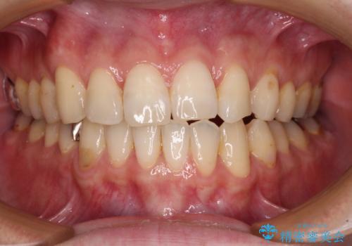 欠損のある歯列　インビザラインで整った歯並びにの治療中