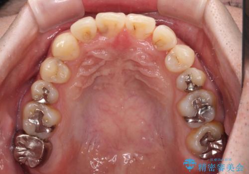 欠損のある歯列　インビザラインで整った歯並びにの治療中