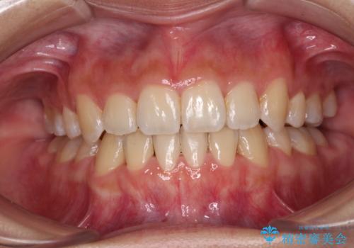 デコボコと八重歯の目立つ前歯　ワイヤー装置による抜歯矯正の症例 治療後