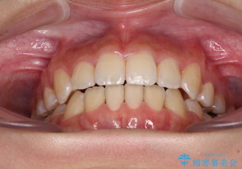 デコボコと八重歯の目立つ前歯 ワイヤー装置による抜歯矯正の治療後