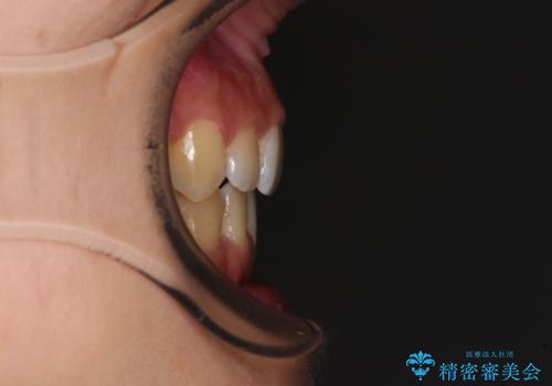 デコボコと八重歯の目立つ前歯　ワイヤー装置による抜歯矯正の治療後
