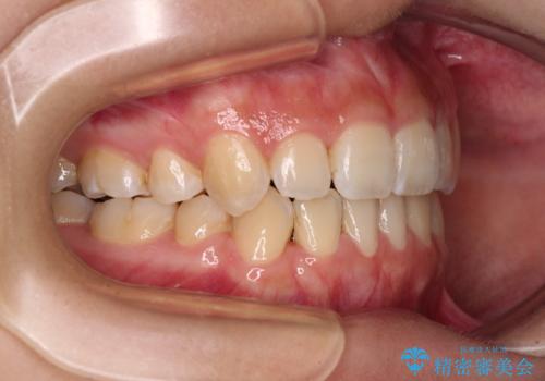 デコボコと八重歯の目立つ前歯 ワイヤー装置による抜歯矯正の治療後