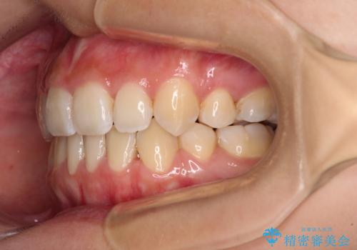 デコボコと八重歯の目立つ前歯 ワイヤー装置による抜歯矯正の治療後