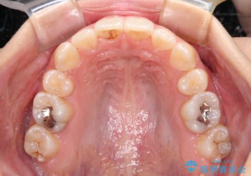 デコボコと八重歯の目立つ前歯　ワイヤー装置による抜歯矯正の治療後