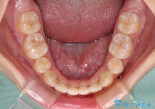 デコボコと八重歯の目立つ前歯 ワイヤー装置による抜歯矯正の治療後