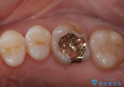 検診で虫歯を発見。の治療後
