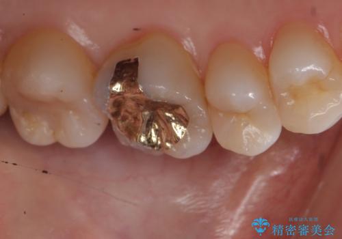 検診で虫歯を発見。の治療後