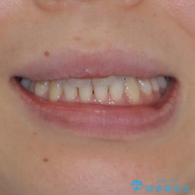 受け口傾向の歯並びをインビザラインで改善の治療後（顔貌）