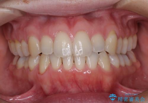 受け口傾向の歯並びをインビザラインで改善の症例 治療後