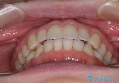 受け口傾向の歯並びをインビザラインで改善の治療後