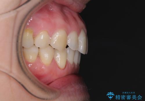 受け口傾向の歯並びをインビザラインで改善の治療後