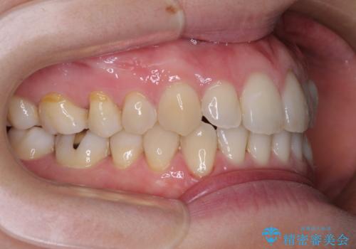 受け口傾向の歯並びをインビザラインで改善の治療後