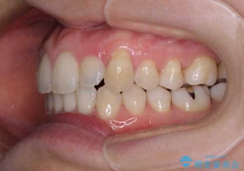 受け口傾向の歯並びをインビザラインで改善の治療後