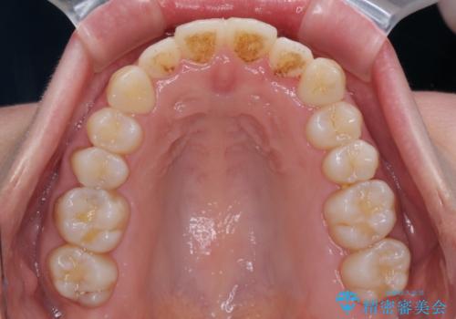 受け口傾向の歯並びをインビザラインで改善の治療後