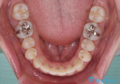 受け口傾向の歯並びをインビザラインで改善の治療後