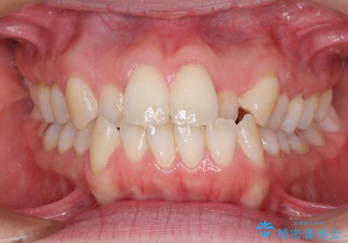 受け口傾向の歯並びをインビザラインで改善の症例 治療前