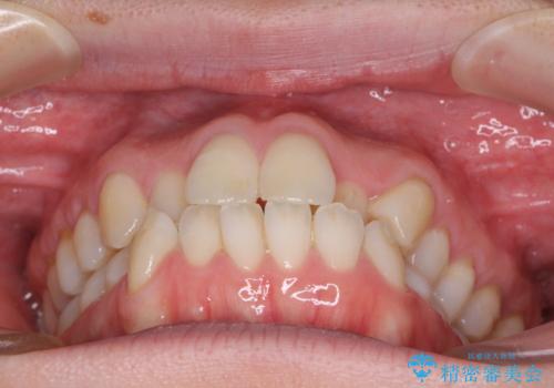 受け口傾向の歯並びをインビザラインで改善の治療前