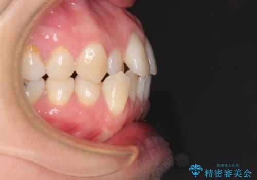 受け口傾向の歯並びをインビザラインで改善の治療前