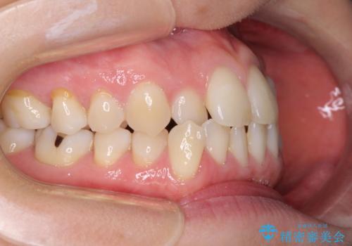 受け口傾向の歯並びをインビザラインで改善の治療前