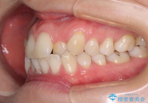 受け口傾向の歯並びをインビザラインで改善の治療前