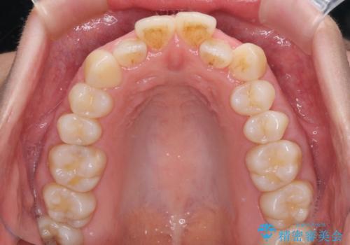 受け口傾向の歯並びをインビザラインで改善の治療前