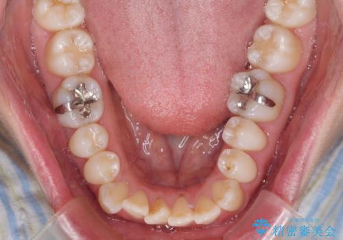受け口傾向の歯並びをインビザラインで改善の治療前