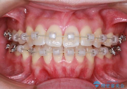 【審美ワイヤー装置】前歯を噛ませたいの治療中
