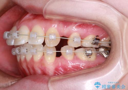 【審美ワイヤー装置】前歯を噛ませたいの治療中