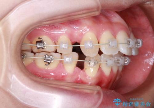 【審美ワイヤー装置】前歯を噛ませたいの治療中