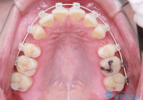 【審美ワイヤー装置】前歯を噛ませたいの治療中