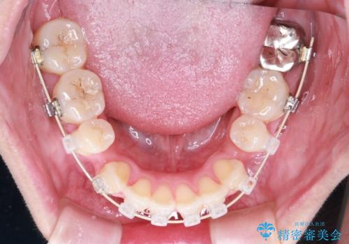 【審美ワイヤー装置】前歯を噛ませたいの治療中