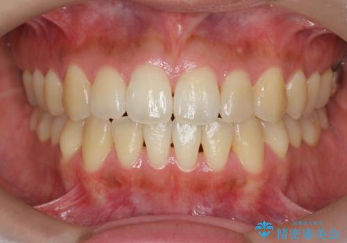 [ 前歯開咬 ]   前歯が噛んでいない マウスピース矯正治療の症例 治療後