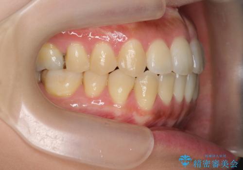 [ 前歯開咬 ]   前歯が噛んでいない マウスピース矯正治療の治療後