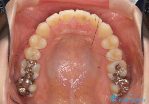 [ 前歯開咬 ]   前歯が噛んでいない マウスピース矯正治療の治療後