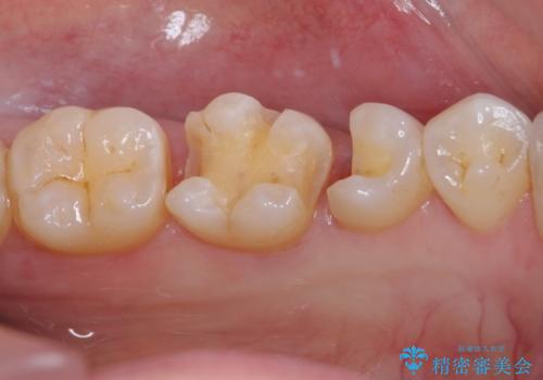 銀歯をセラミックにしたい セラミックインレー修復の治療中