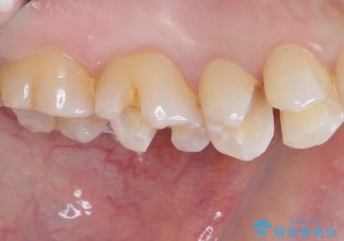 銀歯をセラミックにしたい セラミックインレー修復の治療中