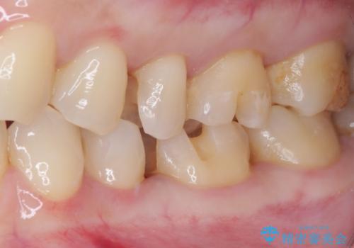 銀歯をセラミックにしたい セラミックインレー修復の治療中