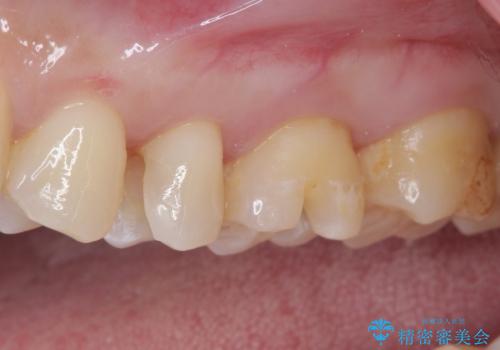 銀歯をセラミックにしたい セラミックインレー修復の治療中
